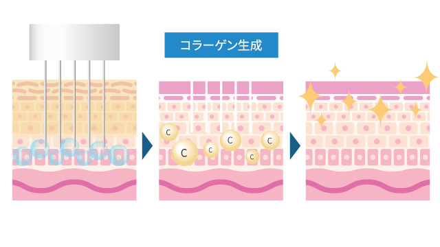 創傷治癒作用で肌再生を促進