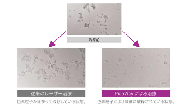 シミ・肝斑・色素沈着に効果的