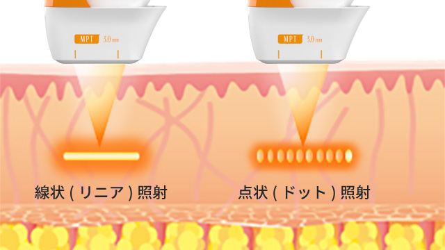 従来よりも優れた医療HIFU機器