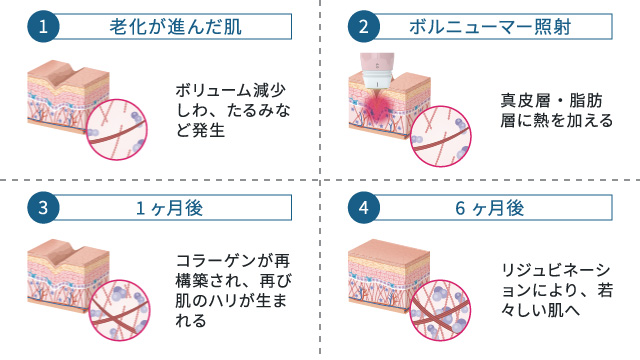 ボルニューマーのメカニズム