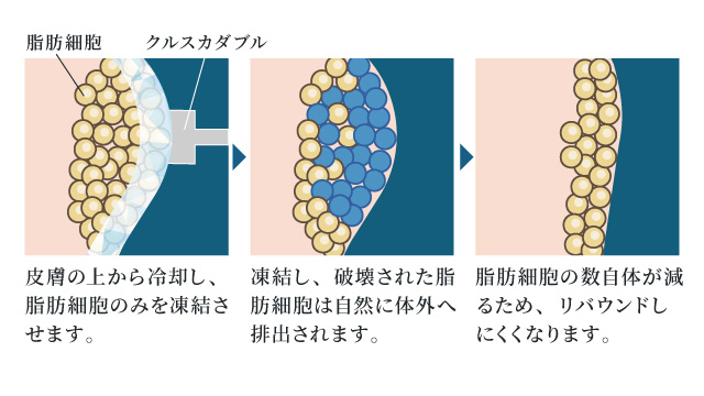 リバウンドしにくい医療ダイエット