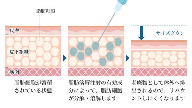 リバウンドしにくい痩身治療